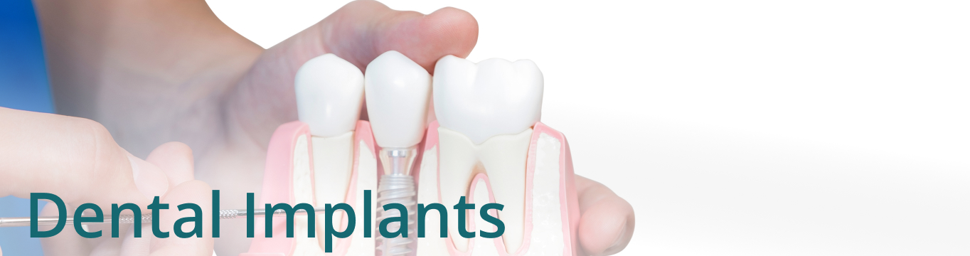 Dental Implants